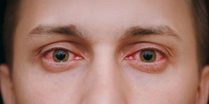 درمان قرمزی چشم و علت بوجود آمدن آن