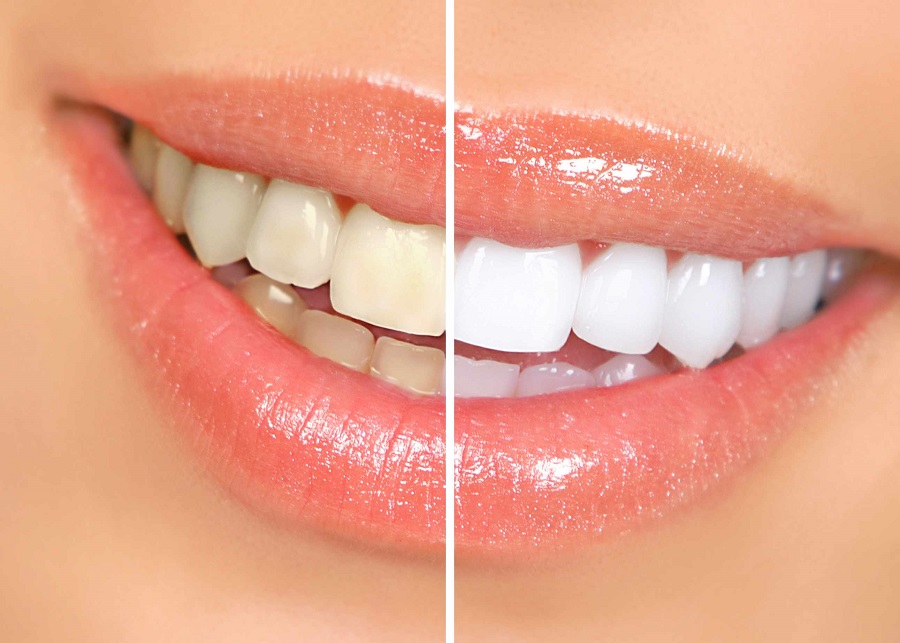 سفید کردن دندان به روش طبیعی در خانه