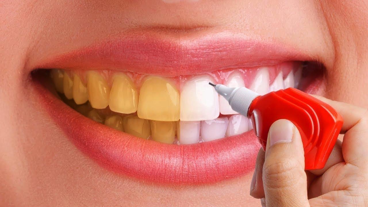 عوارض بلیچینگ دندان چیست؟
