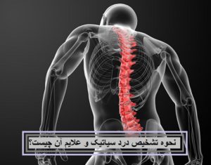 نحوه تشخیص درد سیاتیک و علایم آن چیست؟