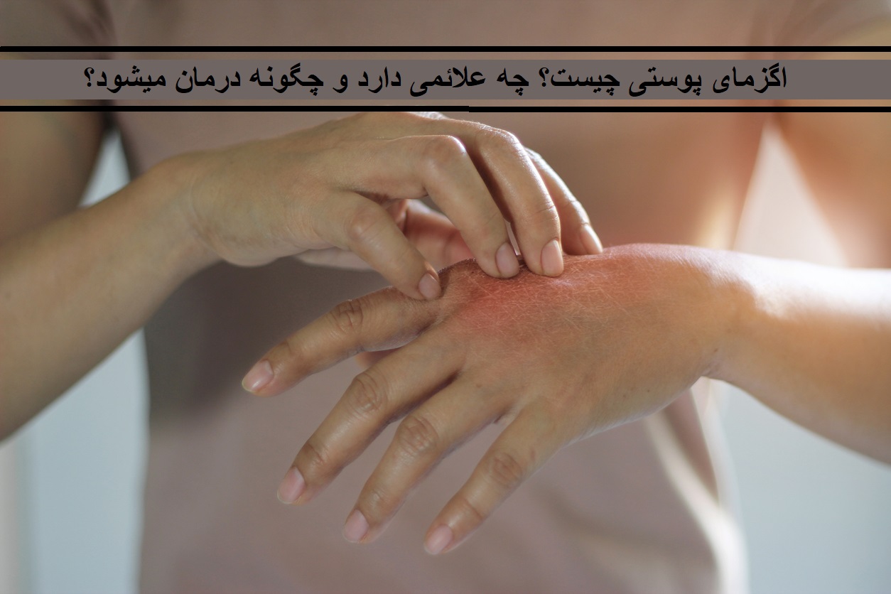 اگزمای پوستی چیست؟ چه علائمی دارد و چگونه درمان میشود؟