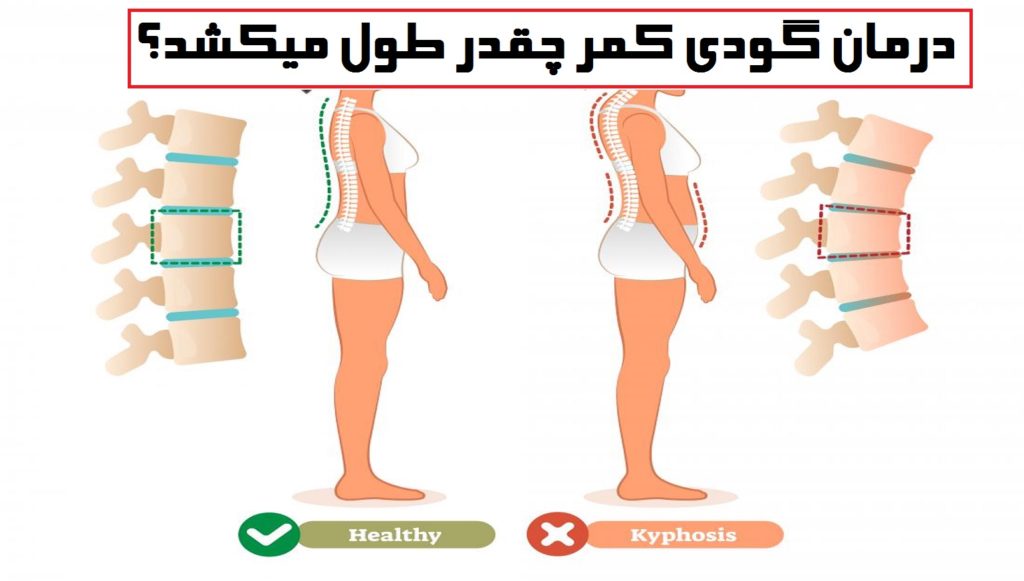 درمان گودی کمر چقدر طول میکشد؟