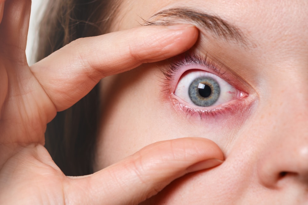 بیماری چشمی شالازیون چیست (تفاوت شالازیون و گل مژه)
