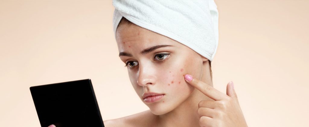 آیا استرس باعث جوش صورت می شود؟ چگونه با آن مقابله کنیم؟