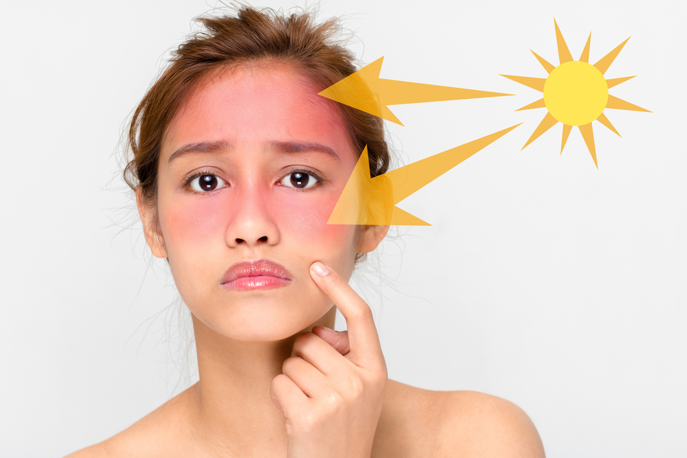 درمان خانگی آفتاب سوختگی چیست؟