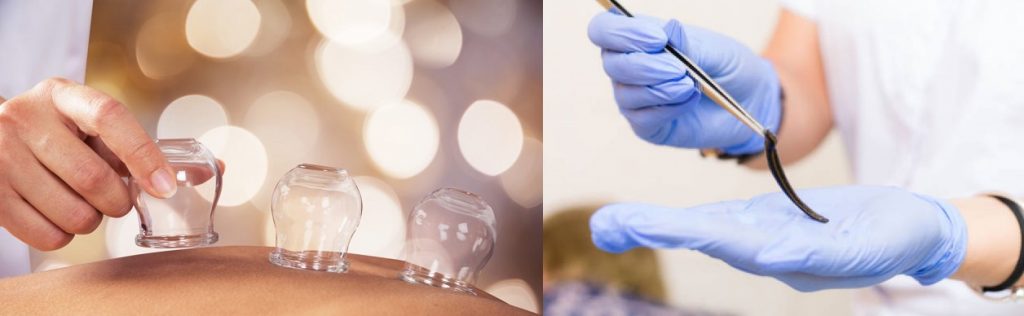 حجامت یا زالو کدام بهتر است؟