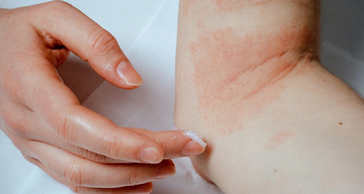 درمان خانگی اگزمای پوستی