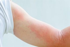 کمبود چه ویتامینی باعث اگزما می شود؟