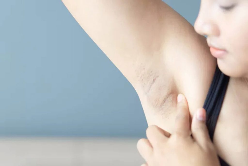 درمان سیاهی زیربغل با جوش شیرین و 8 روش دیگر