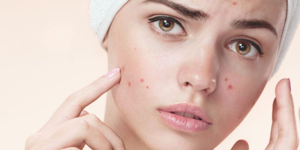 درمان جوش صورت در یک روز