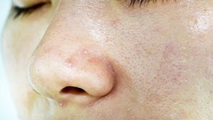 درمان جوش های صورت بعد از عمل بینی