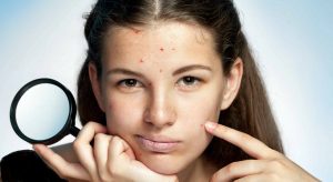 15 روش برای پیشگیری از جوش زدن صورت