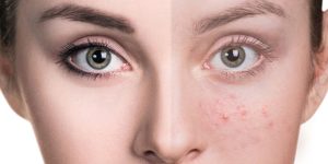 دعا برای رفع جوش صورت (درمان معنوی جوش و لک)