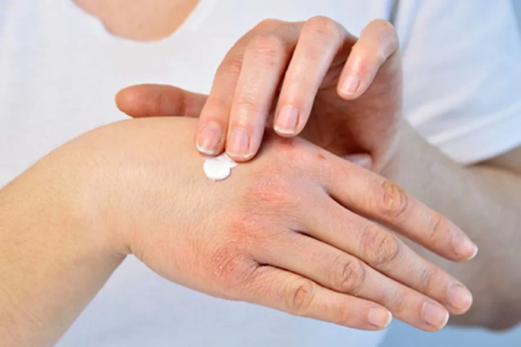 زینک اکساید برای سوختگی (آیا مفید است و موارد مصرف)