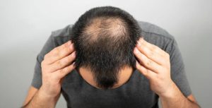 عوارض و فواید کاشت مو (آیا ارزشمند است)