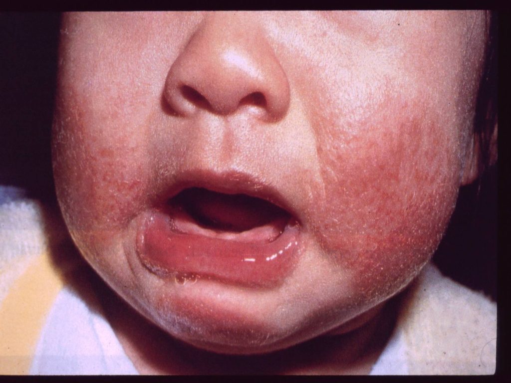 انواع حساسیت پوستی در کودکان و نوزادان 