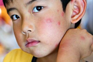 انواع حساسیت پوستی در کودکان و نوزادان با عکس