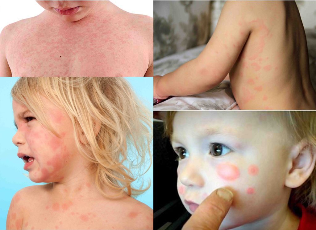 کهیر در کودکان - حساسیت های پوستی کودکان