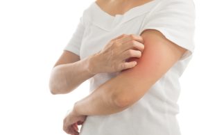 کهیر چیست و علت آن + روش های رفع کهیر معمولی و مزمن